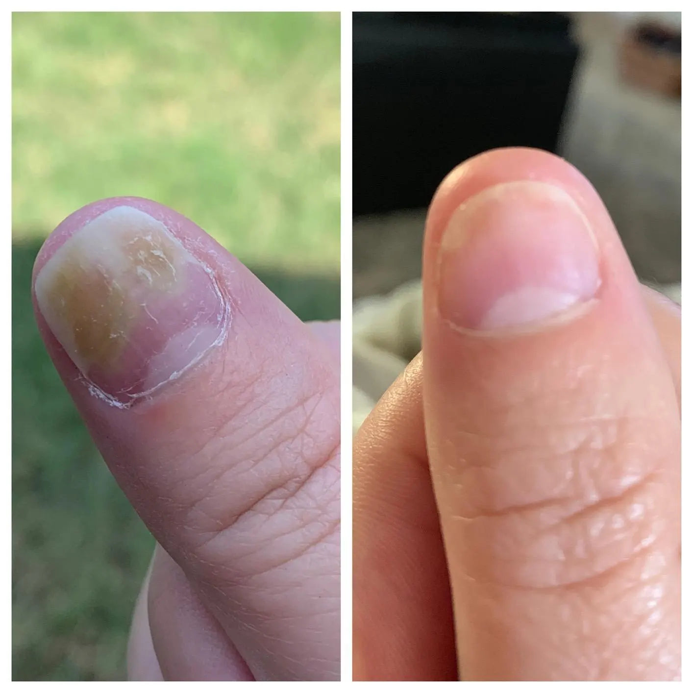 Swissclear™ LLLT Device + Free Fungal Patches