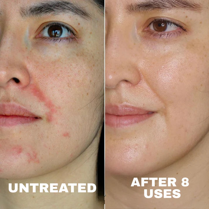 Ocean - Natural Eczema Calming Complex
