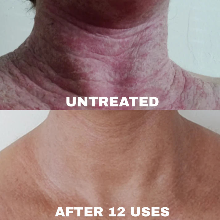 Ocean - Natural Eczema Calming Complex