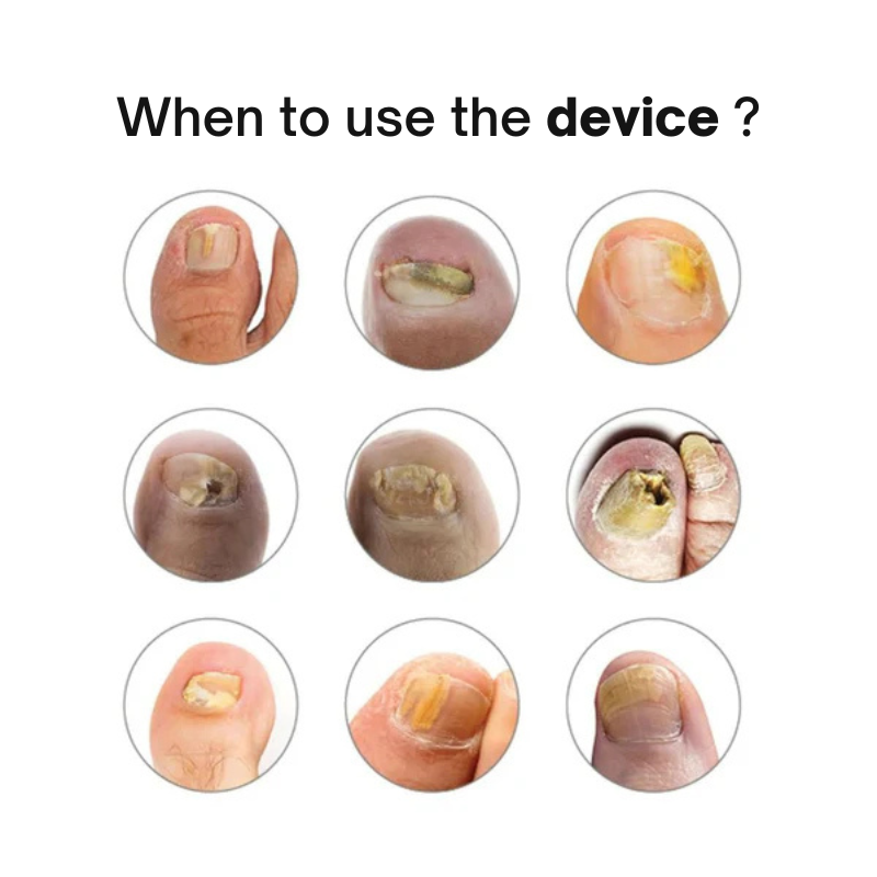 Swissclear Anti-Fungal Device