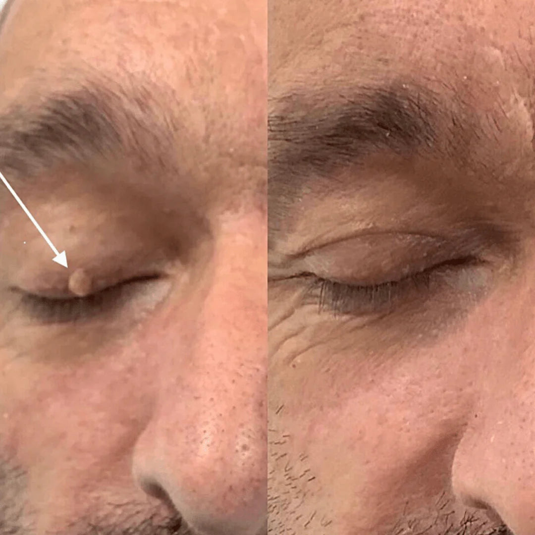 Swissclear Plasma Pen