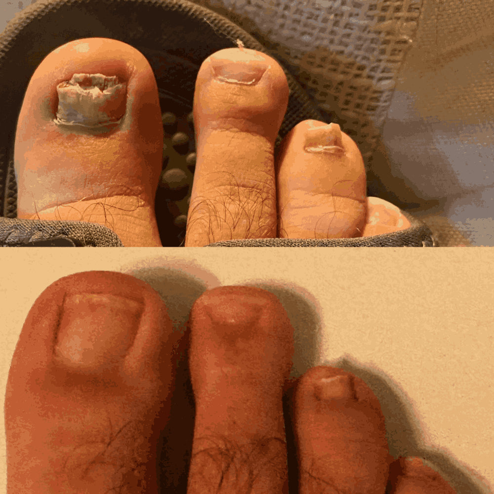 Swissclear™ LLLT Device + Free Fungal Patches