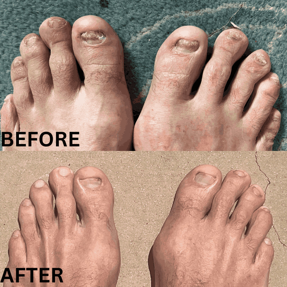 Swissclear™ LLLT Device + Free Fungal Patches
