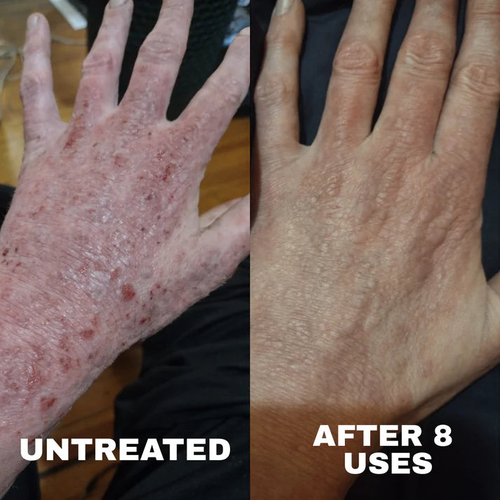 Ocean - Natural Eczema Calming Complex