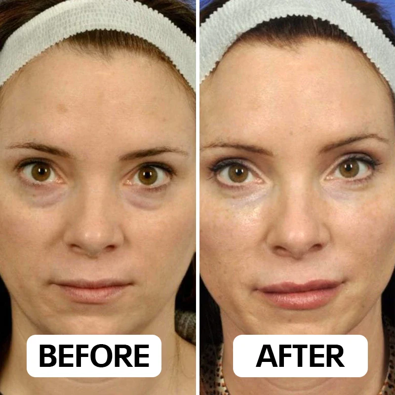 Neux Radiance™ Handset by Neoclear